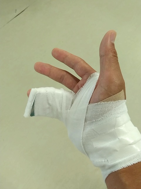 骨折した右手
